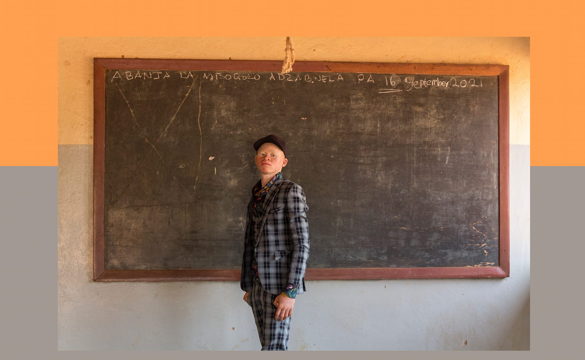 chico-con-albinismo-áfrica