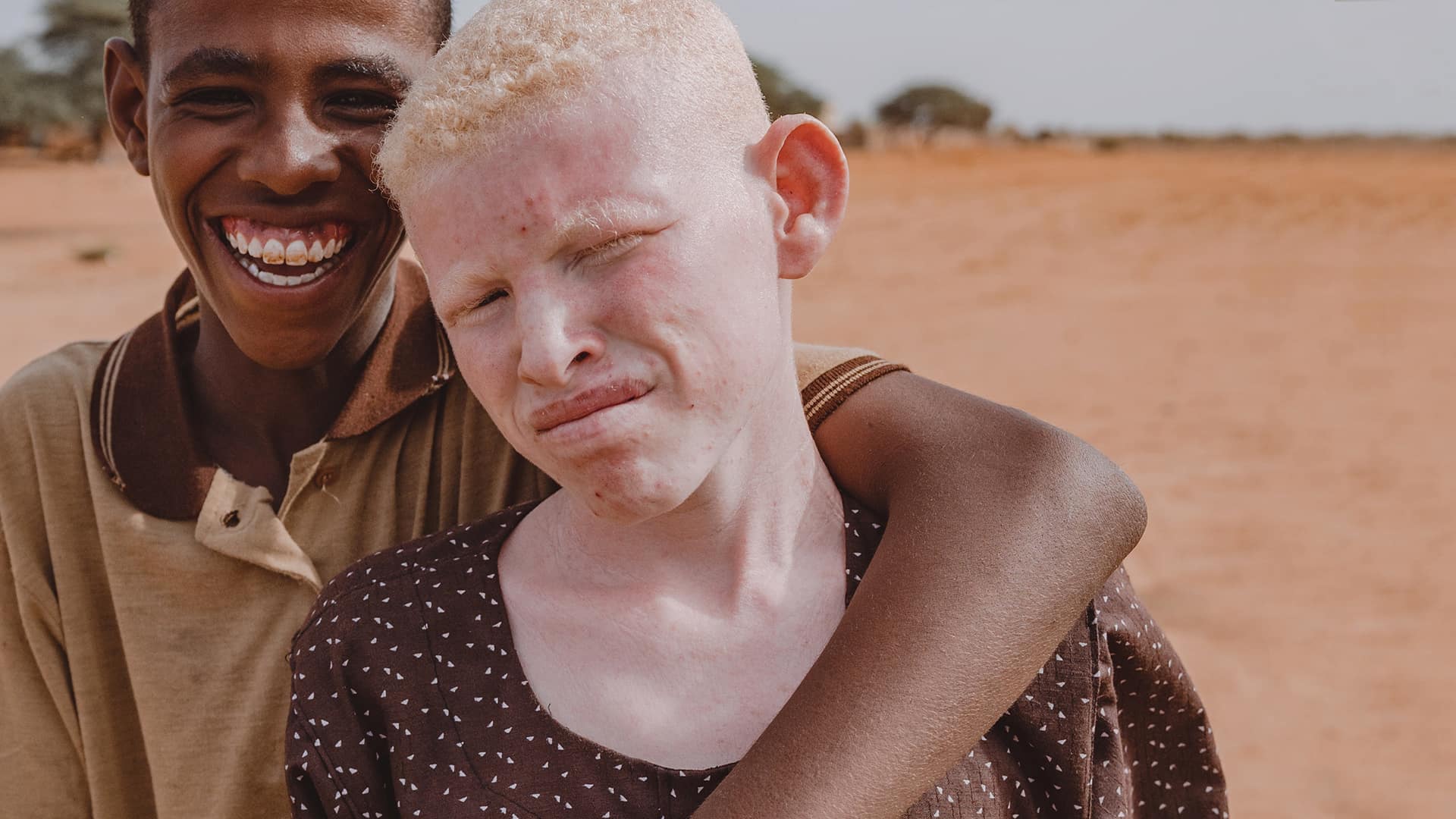 chico negro con albinismo